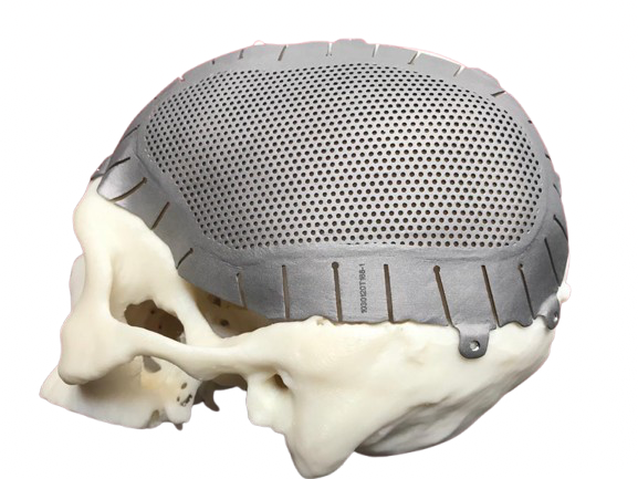 Cranial Implants